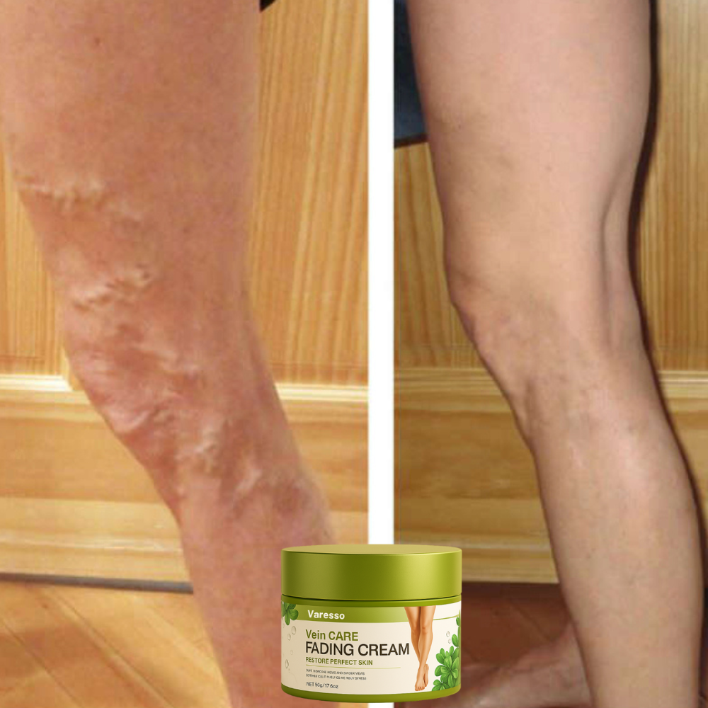 Varesso™ Varicose Vein Cream | avlägsnar 96% av åderbråcken på 3 dagar