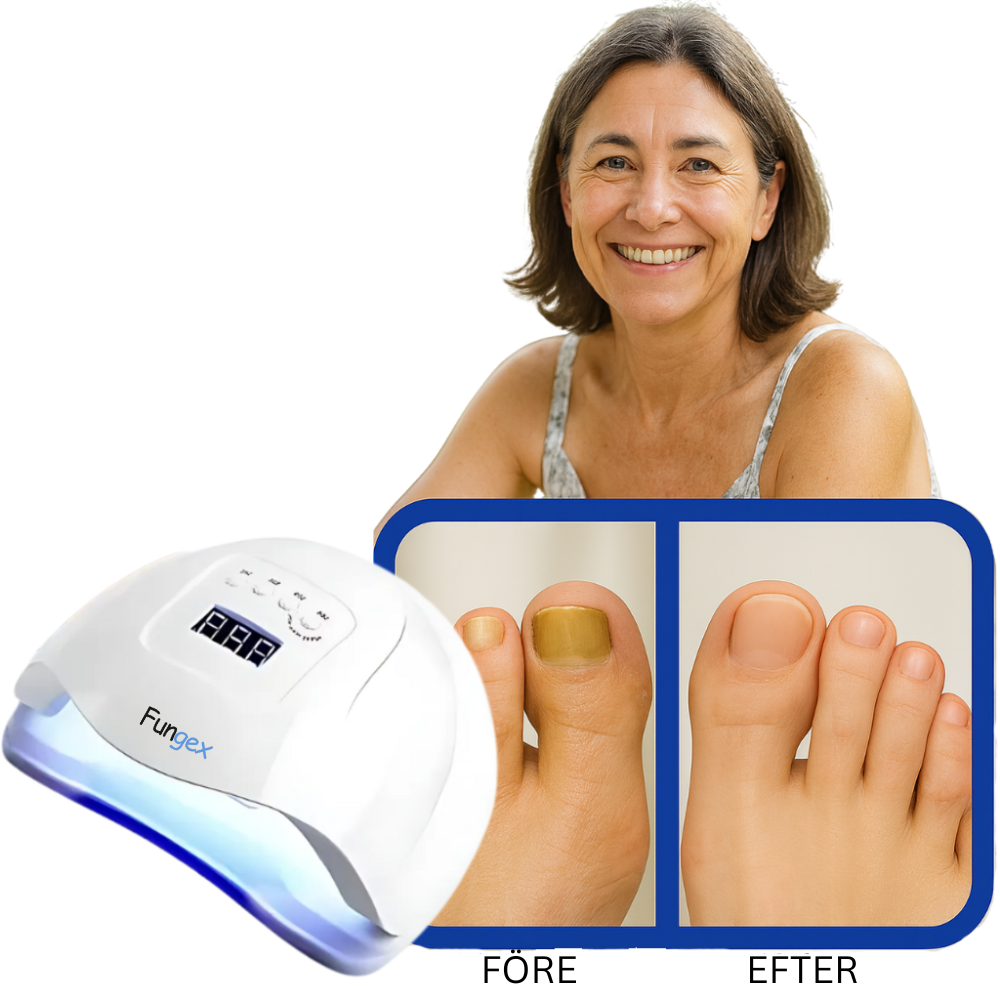 Fungex™ Anti Fungal Device | Tar bort 99% av nagelsvampen på 7 dagar