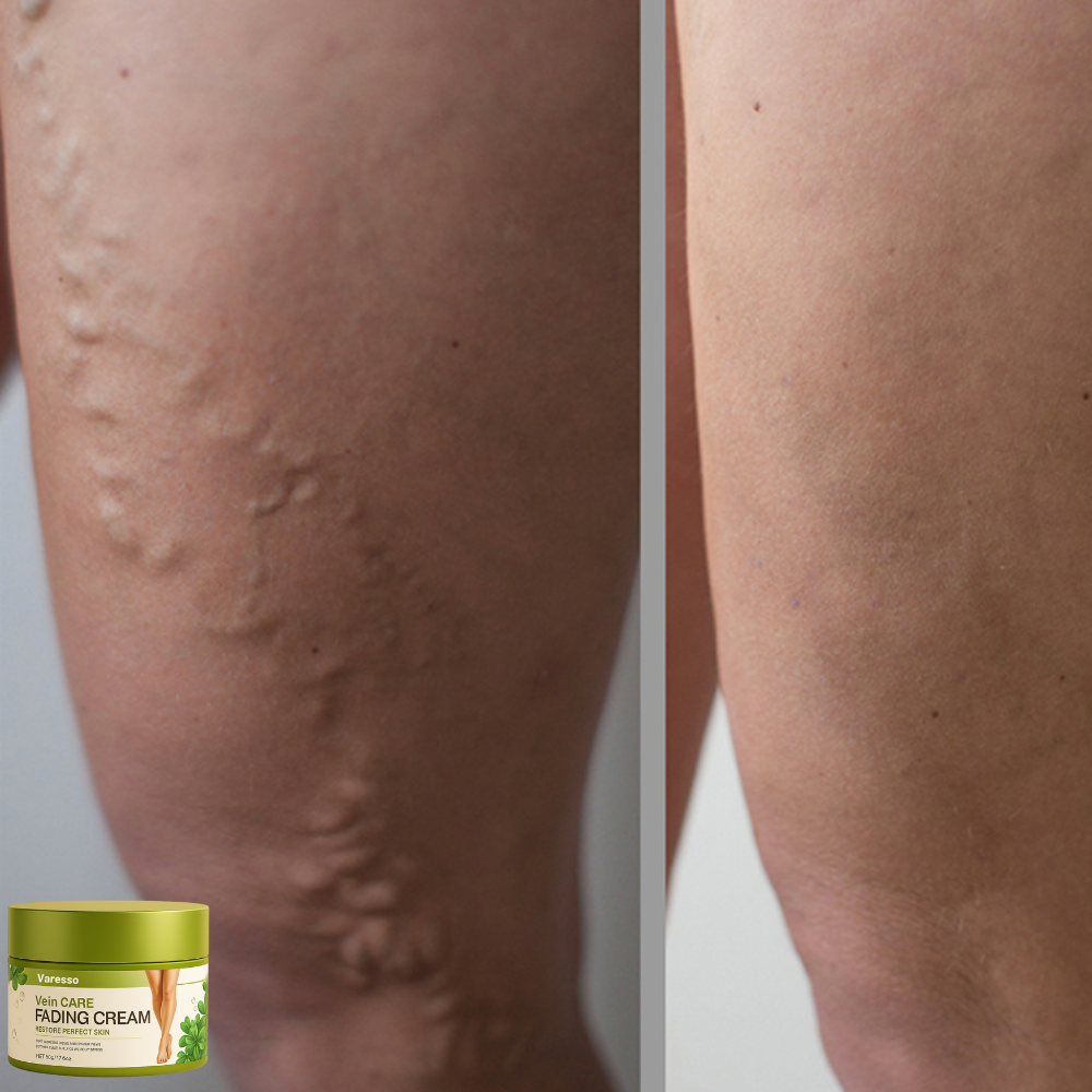 Varesso™ Varicose Vein Cream | avlägsnar 96% av åderbråcken på 3 dagar
